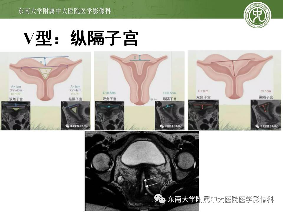 【病例】子宫发育畸形(纵隔子宫)1例MR