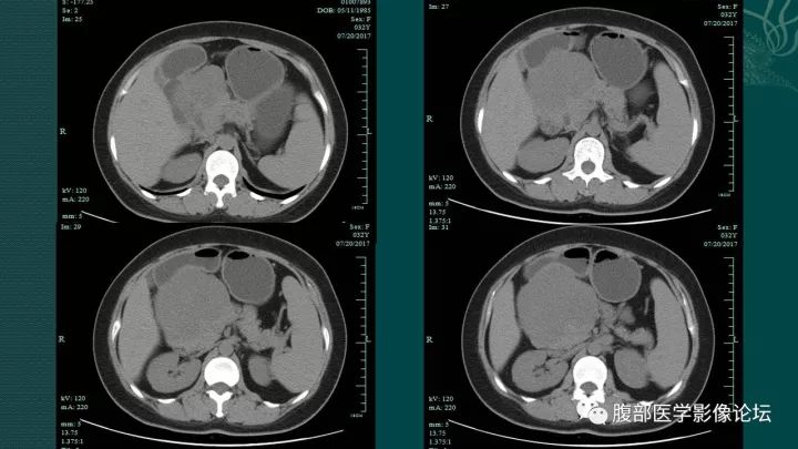 【病例】胰腺实性假乳头状肿瘤1例CT及MR影像表现 【病例】胰腺实性假乳头状肿瘤1例CT及MR影像表现