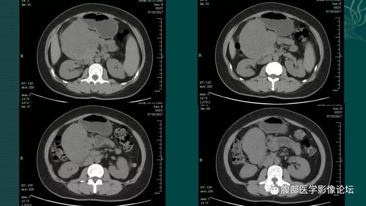 【病例】胰腺实性假乳头状肿瘤1例CT及MR影像表现 【病例】胰腺实性假乳头状肿瘤1例CT及MR影像表现