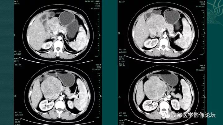 【病例】胰腺实性假乳头状肿瘤1例CT及MR影像表现 【病例】胰腺实性假乳头状肿瘤1例CT及MR影像表现