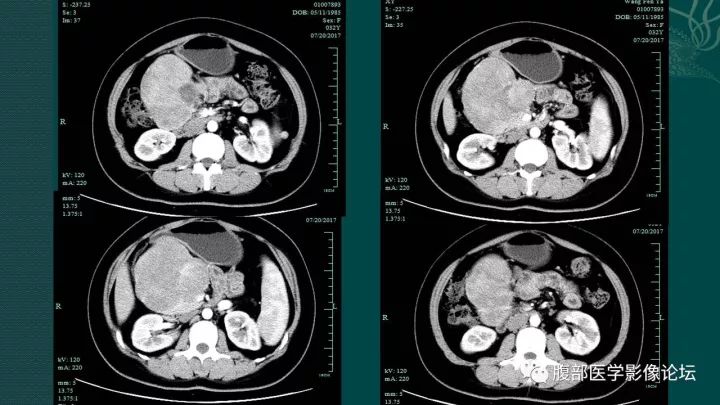 【病例】胰腺实性假乳头状肿瘤1例CT及MR影像表现 【病例】胰腺实性假乳头状肿瘤1例CT及MR影像表现