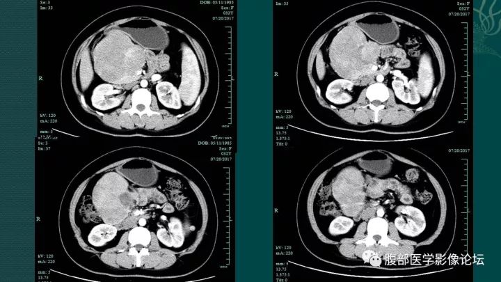 【病例】胰腺实性假乳头状肿瘤1例CT及MR影像表现 【病例】胰腺实性假乳头状肿瘤1例CT及MR影像表现