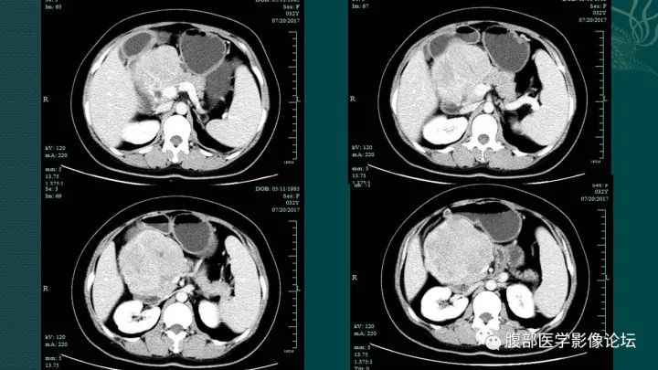 【病例】胰腺实性假乳头状肿瘤1例CT及MR影像表现 【病例】胰腺实性假乳头状肿瘤1例CT及MR影像表现