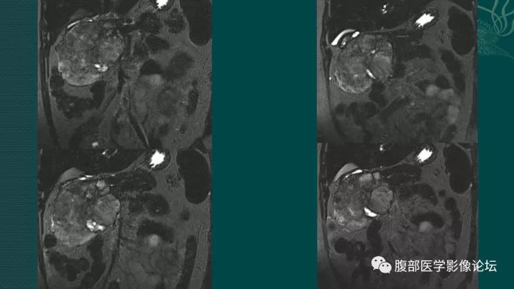 【病例】胰腺实性假乳头状肿瘤1例CT及MR影像表现 【病例】胰腺实性假乳头状肿瘤1例CT及MR影像表现