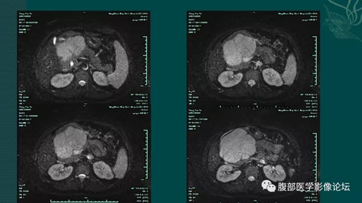 【病例】胰腺实性假乳头状肿瘤1例CT及MR影像表现 【病例】胰腺实性假乳头状肿瘤1例CT及MR影像表现