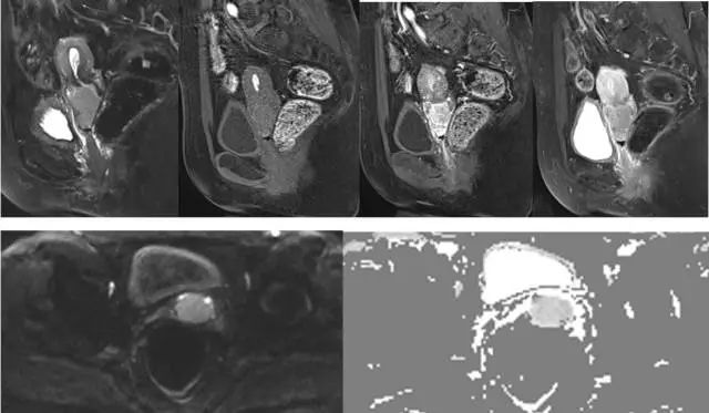 妇产科常见疾病的MRI 表现 妇产科常见疾病的MRI 表现