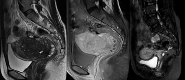 妇产科常见疾病的MRI 表现 妇产科常见疾病的MRI 表现
