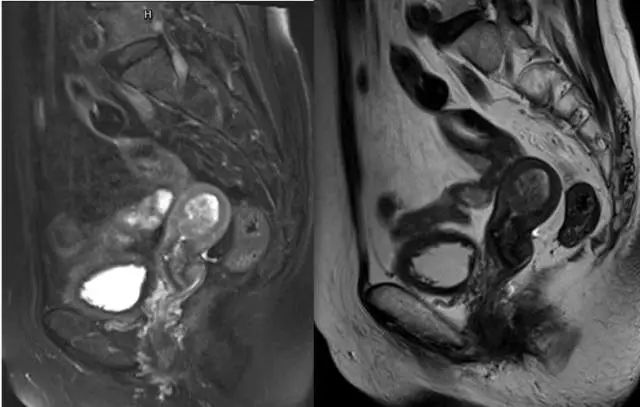 妇产科常见疾病的MRI 表现 妇产科常见疾病的MRI 表现