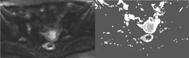 妇产科常见疾病的MRI 表现 妇产科常见疾病的MRI 表现