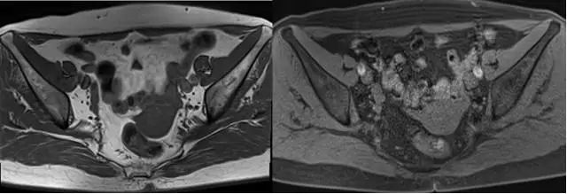 妇产科常见疾病的MRI 表现 妇产科常见疾病的MRI 表现