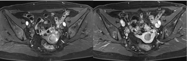 妇产科常见疾病的MRI 表现 妇产科常见疾病的MRI 表现