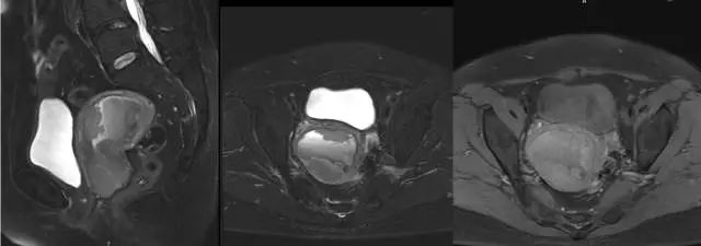 妇产科常见疾病的MRI 表现 妇产科常见疾病的MRI 表现