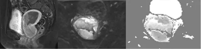 妇产科常见疾病的MRI 表现