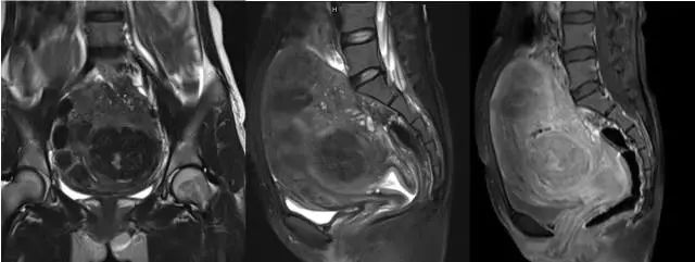 妇产科常见疾病的MRI 表现 妇产科常见疾病的MRI 表现