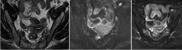 妇产科常见疾病的MRI 表现