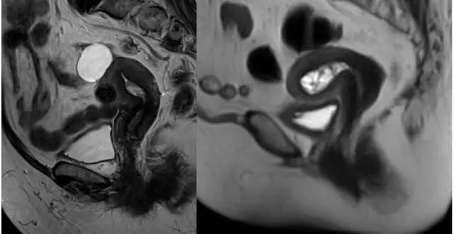 妇产科常见疾病的MRI 表现