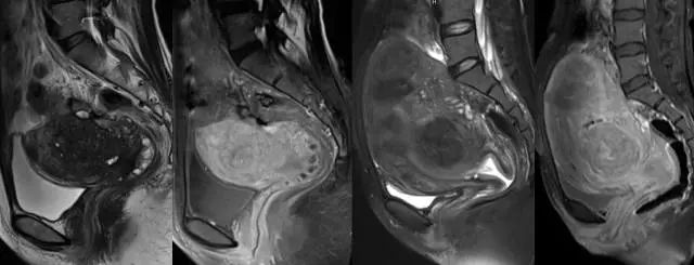 妇产科常见疾病的MRI 表现