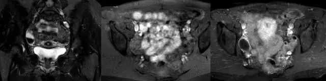 妇产科常见疾病的MRI 表现 妇产科常见疾病的MRI 表现