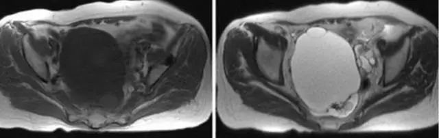 妇产科常见疾病的MRI 表现 妇产科常见疾病的MRI 表现