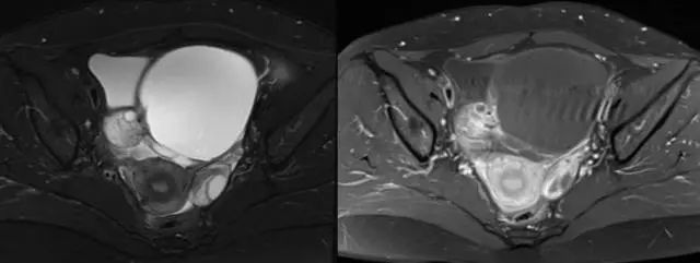 妇产科常见疾病的MRI 表现