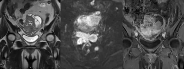 妇产科常见疾病的MRI 表现 妇产科常见疾病的MRI 表现