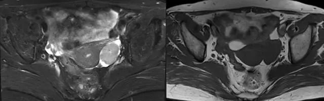 妇产科常见疾病的MRI 表现 妇产科常见疾病的MRI 表现
