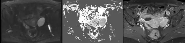 妇产科常见疾病的MRI 表现