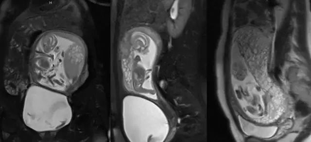 妇产科常见疾病的MRI 表现
