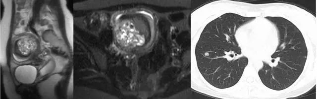 妇产科常见疾病的MRI 表现
