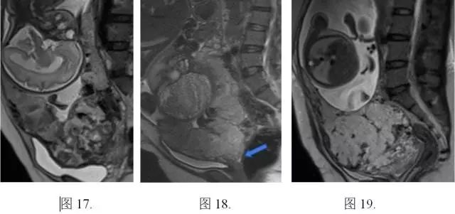 妇产科常见疾病的MRI 表现 妇产科常见疾病的MRI 表现