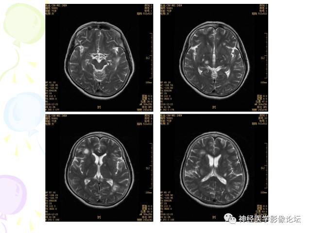 【病例】易误诊为多发性硬化的脑囊虫病1例CT及MR
