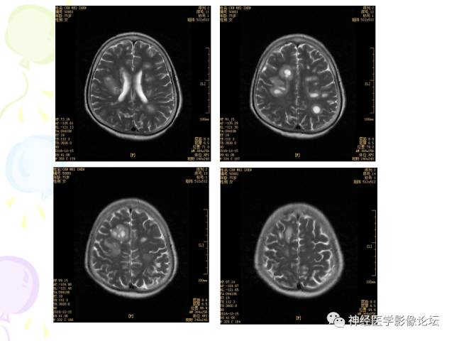 【病例】易误诊为多发性硬化的脑囊虫病1例CT及MR