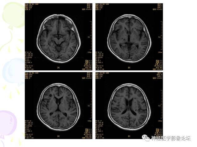 【病例】易误诊为多发性硬化的脑囊虫病1例CT及MR