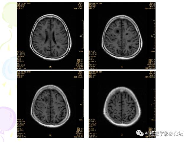 【病例】易误诊为多发性硬化的脑囊虫病1例CT及MR