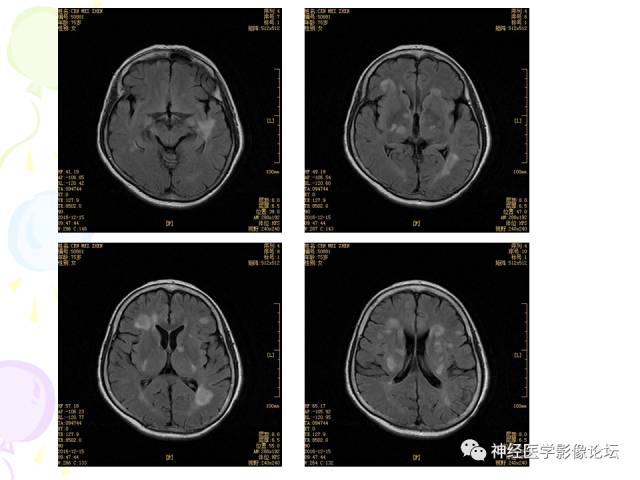 【病例】易误诊为多发性硬化的脑囊虫病1例CT及MR