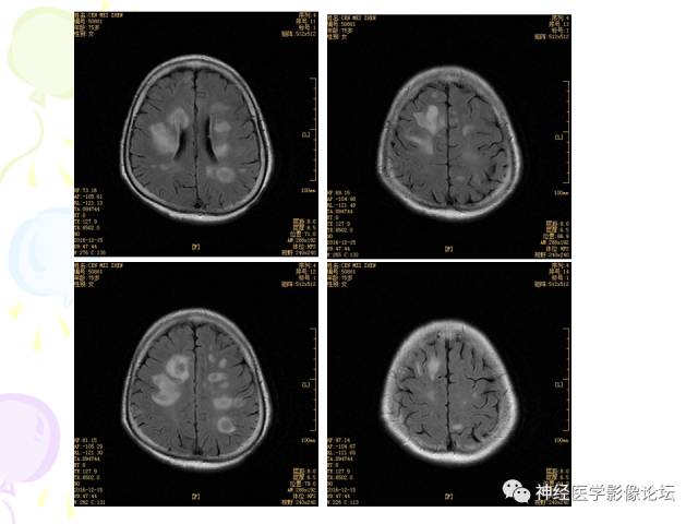 【病例】易误诊为多发性硬化的脑囊虫病1例CT及MR