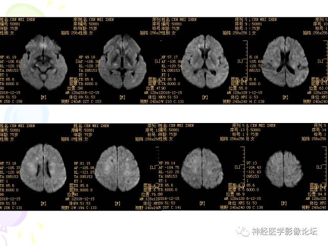 【病例】易误诊为多发性硬化的脑囊虫病1例CT及MR