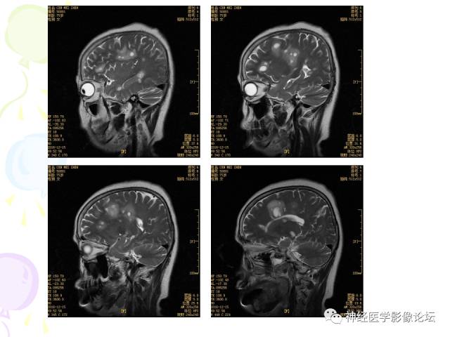 【病例】易误诊为多发性硬化的脑囊虫病1例CT及MR