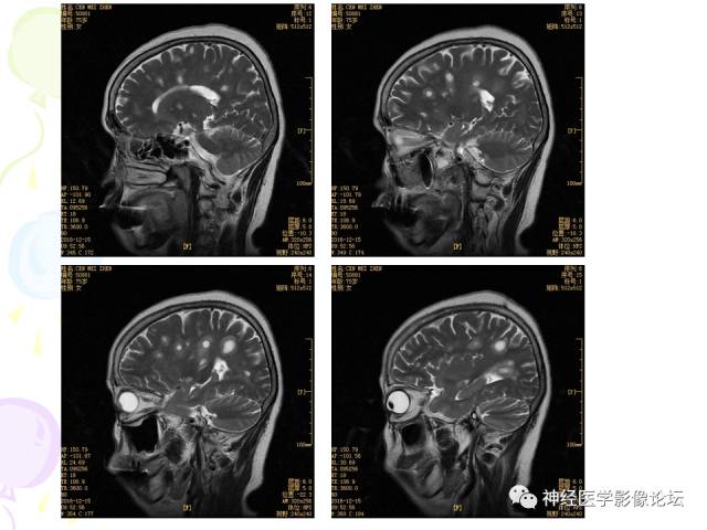 【病例】易误诊为多发性硬化的脑囊虫病1例CT及MR