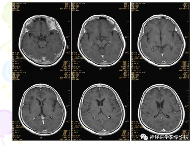 【病例】易误诊为多发性硬化的脑囊虫病1例CT及MR