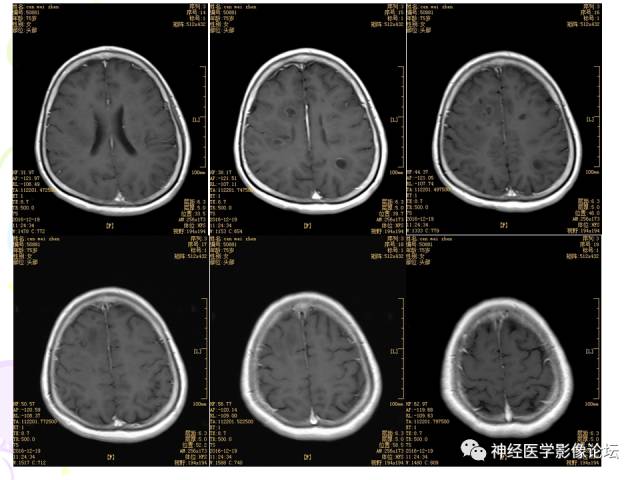 【病例】易误诊为多发性硬化的脑囊虫病1例CT及MR
