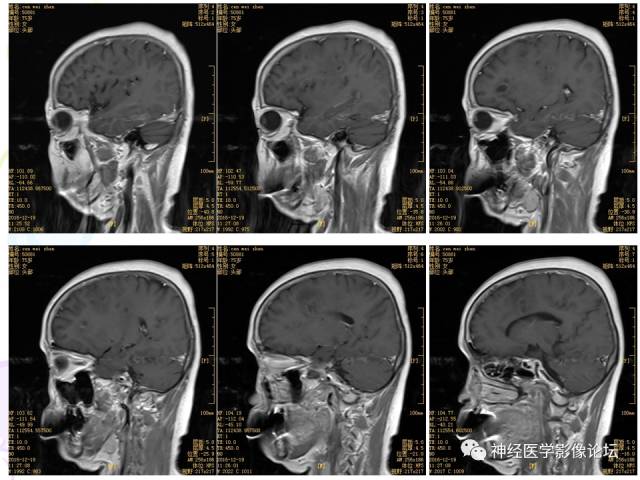 【病例】易误诊为多发性硬化的脑囊虫病1例CT及MR