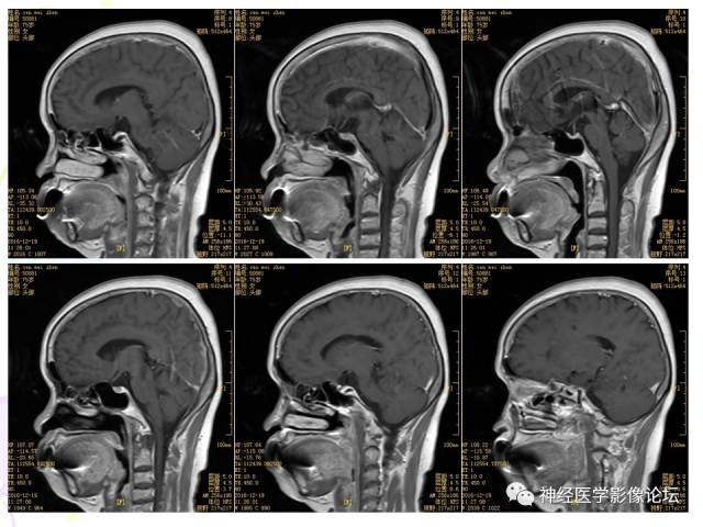 【病例】易误诊为多发性硬化的脑囊虫病1例CT及MR