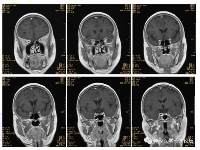 【病例】易误诊为多发性硬化的脑囊虫病1例CT及MR