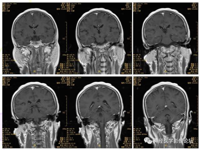 【病例】易误诊为多发性硬化的脑囊虫病1例CT及MR