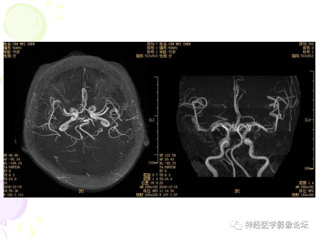 【病例】易误诊为多发性硬化的脑囊虫病1例CT及MR