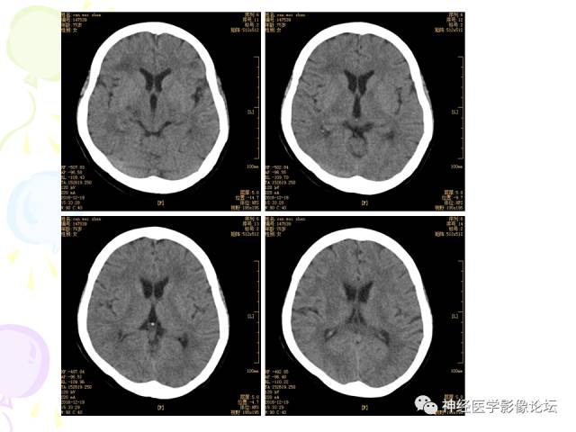 【病例】易误诊为多发性硬化的脑囊虫病1例CT及MR