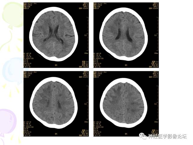 【病例】易误诊为多发性硬化的脑囊虫病1例CT及MR