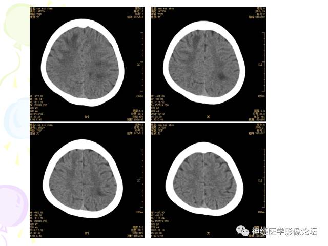 【病例】易误诊为多发性硬化的脑囊虫病1例CT及MR
