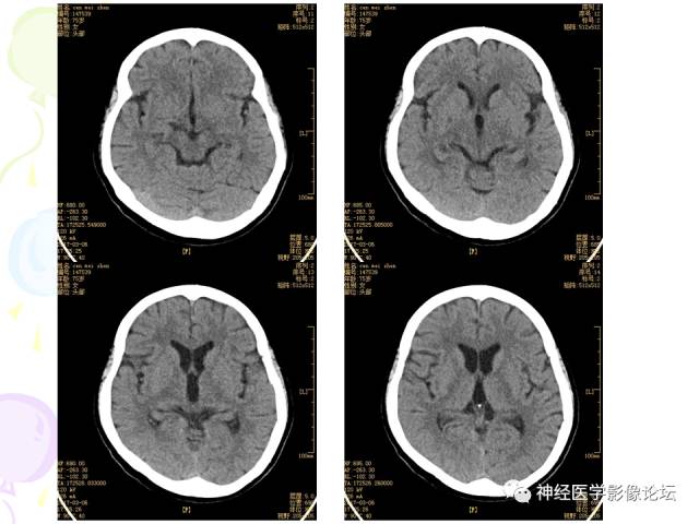 【病例】易误诊为多发性硬化的脑囊虫病1例CT及MR